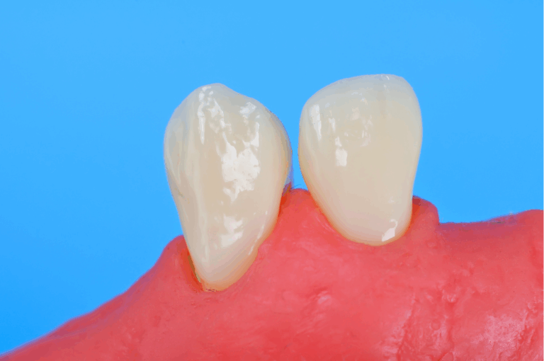 Maintaining proper tooth care