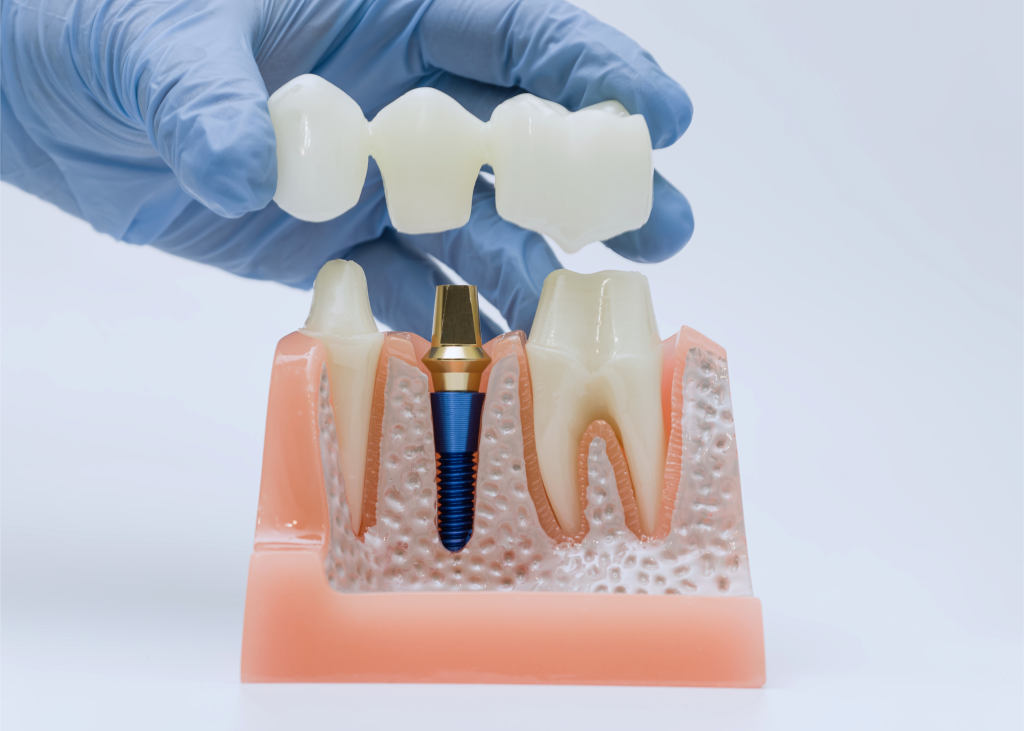 How long does a dental crown take? Compare traditional and same-day crown timelines, appointment lengths, recovery, and what can delay treatment.