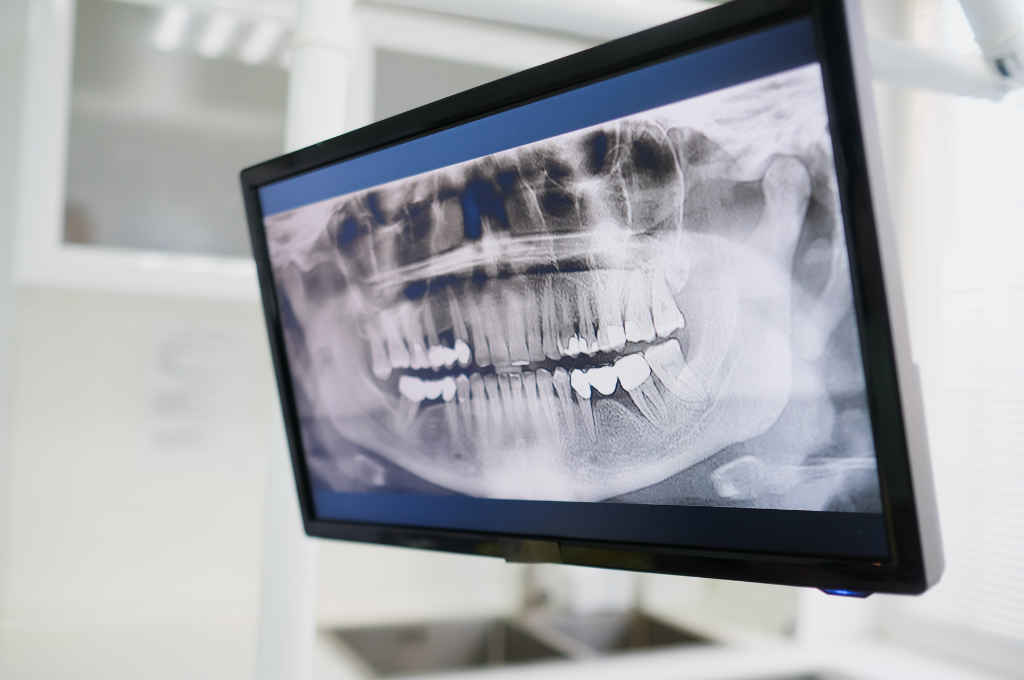 xray with teeth grinding wear